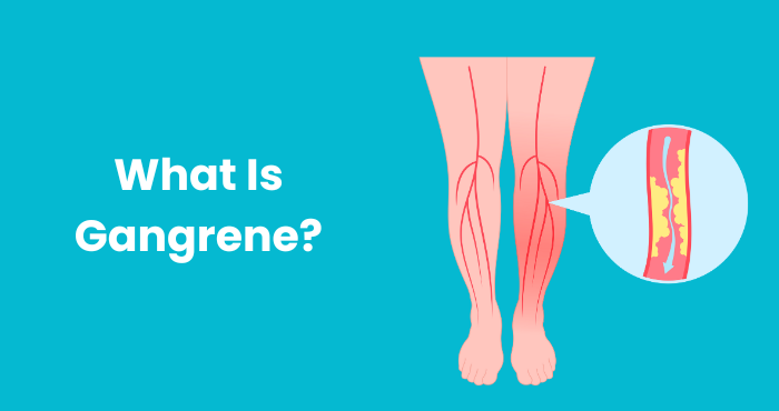 What Is Gangrene?